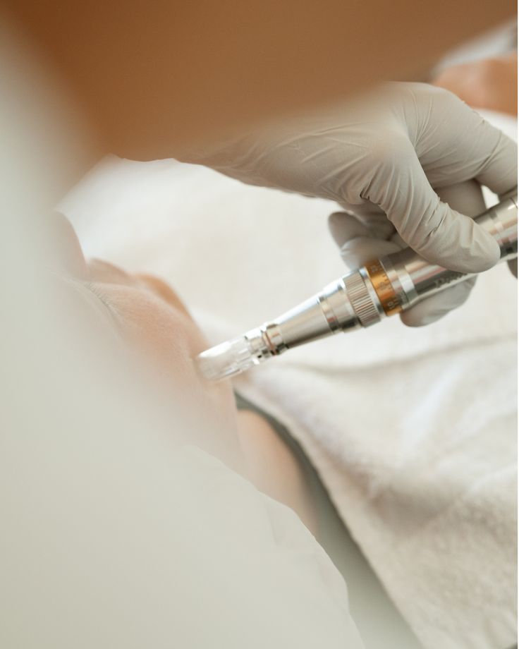 Microneedlingapparaat op de huid